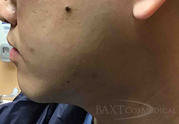 Mole Removal Before - Paramus, NJ Mole Removal Before - Paramus, NJ