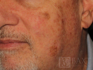 Mole Removal Before - Paramus, NJ