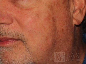 Mole Removal After - Paramus, NJ