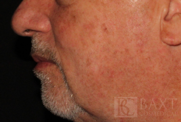 Mole Removal After - Paramus, NJ