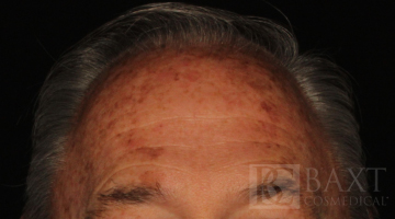 Mole Removal Before - Paramus, NJ