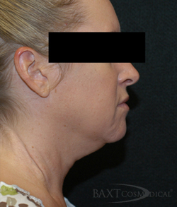 Neck Contouring Before - Paramus, NJ Neck Contouring Before - Paramus, NJ