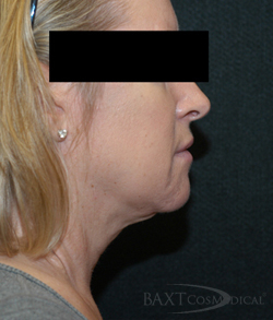 Neck Contouring After - Paramus, NJ Neck Contouring After - Paramus, NJ