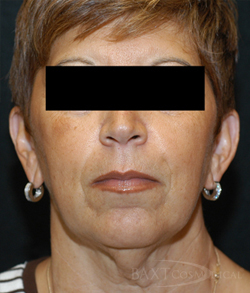 Neck Contouring Before - Paramus, NJ Neck Contouring Before - Paramus, NJ
