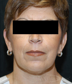 Neck Contouring After - Paramus, NJ Neck Contouring After - Paramus, NJ
