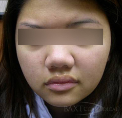 Photodynamic Therapy - After - Paramus, NJ Photodynamic Therapy - After - Paramus, NJ