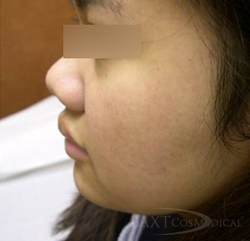 Photodynamic Therapy - After - Paramus, NJ Photodynamic Therapy - After - Paramus, NJ