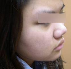 Photodynamic Therapy - After - Paramus, NJ Photodynamic Therapy - After - Paramus, NJ