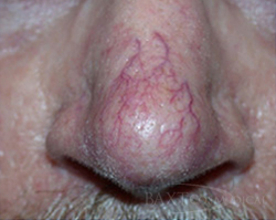 Photofacial Before - Paramus, NJ Photofacial Before - Paramus, NJ