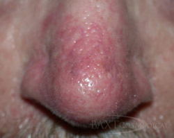 Photofacial After - Paramus, NJ Photofacial After - Paramus, NJ