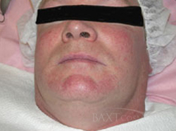 Before IPL for rosacea