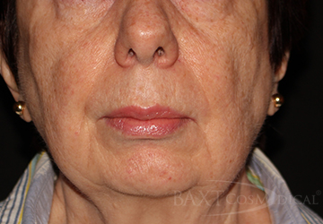 Photofacial Before - Paramus, NJ Photofacial Before - Paramus, NJ