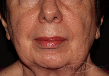 Photofacial After - Paramus, NJ Photofacial After - Paramus, NJ