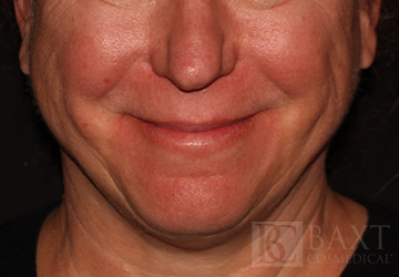 Photofacial Before - Paramus, NJ