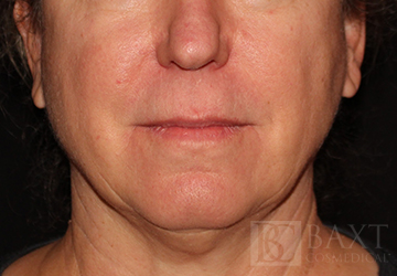 Photofacial After - Paramus, NJ