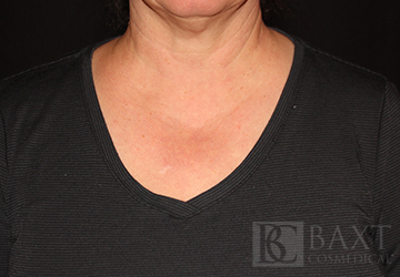 Photofacial After - Paramus, NJ