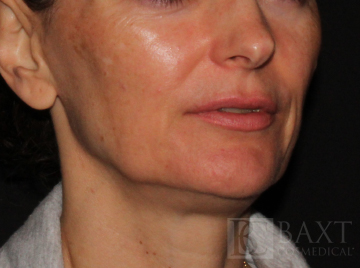 Photofacial Before - Paramus, NJ Photofacial Before - Paramus, NJ