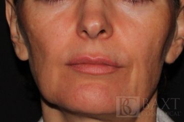 Photofacial Before - Paramus, NJ Photofacial Before - Paramus, NJ