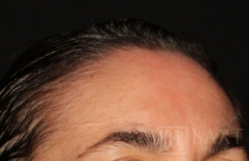 Photofacial After - Paramus, NJ Photofacial After - Paramus, NJ