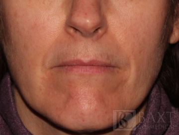 Photofacial After - Paramus, NJ Photofacial After - Paramus, NJ