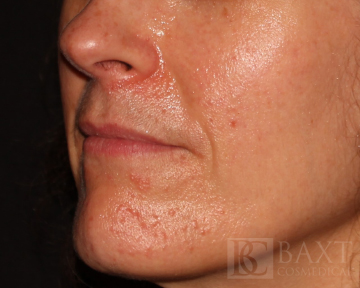 Photofacial Before - Paramus, NJ Photofacial Before - Paramus, NJ