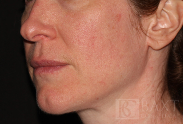 Photofacial Before - Paramus, NJ
