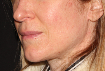 Photofacial After - Paramus, NJ
