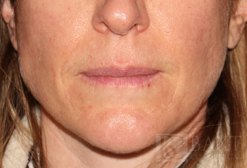 Photofacial After - Paramus, NJ