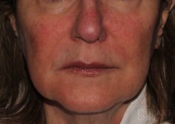 Photofacial Before - Paramus, NJ