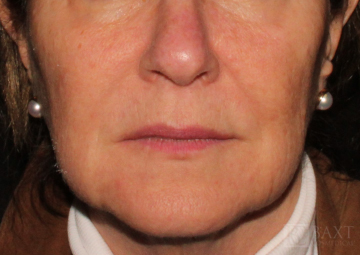 Photofacial After - Paramus, NJ