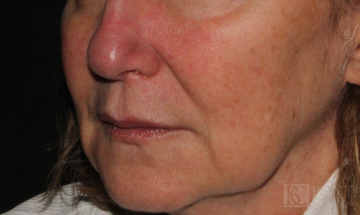 Photofacial Before - Paramus, NJ