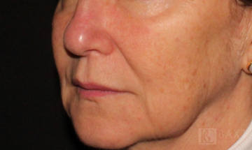 Photofacial After - Paramus, NJ