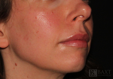 Photofacial Before - Paramus, NJ