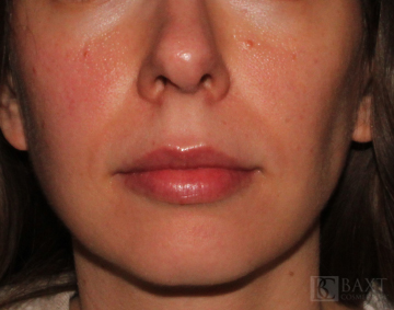 Photofacial Before - Paramus, NJ