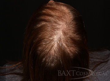 Chemical Peels Before - Paramus, NJ PRP Hair Restoration Before - Paramus, NJ