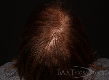 PRP Hair Restoration After - Paramus, NJ PRP Hair Restoration After - Paramus, NJ