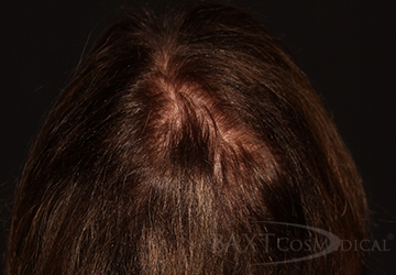 Closeup of patient before hair restoration treatment