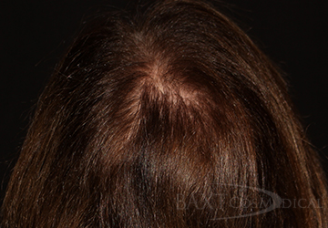 Closeup of patient after hair restoration treatment