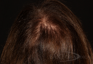 PRP Hair Restoration After - Paramus, NJ PRP Hair Restoration After - Paramus, NJ