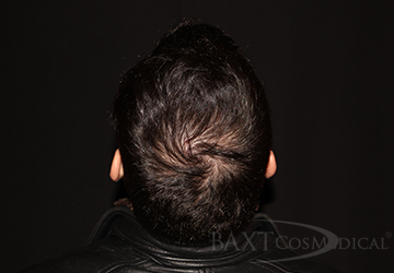 Chemical Peels Before - Paramus, NJ PRP Hair Restoration Before - Paramus, NJ