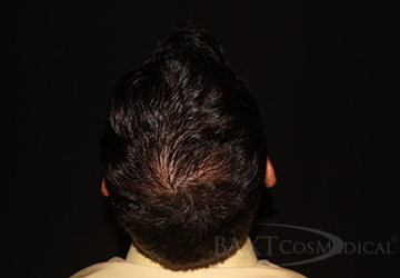 PRP Hair Restoration After - Paramus, NJ PRP Hair Restoration After - Paramus, NJ