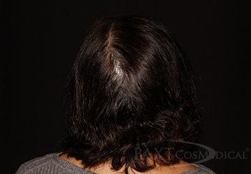 Chemical Peels Before - Paramus, NJ PRP Hair Restoration Before - Paramus, NJ