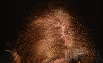 Hair Restoration Peels Before - Paramus, NJ Hair Restoration Before - Paramus, NJ