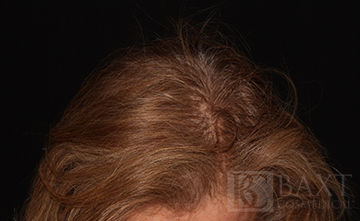 Hair Restoration After - Paramus, NJ Hair Restoration After - Paramus, NJ