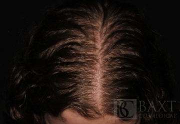 Hair Restoration Peels Before - Paramus, NJ Hair Restoration Before - Paramus, NJ