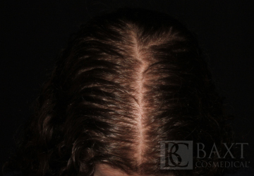 Hair Restoration After - Paramus, NJ Hair Restoration After - Paramus, NJ
