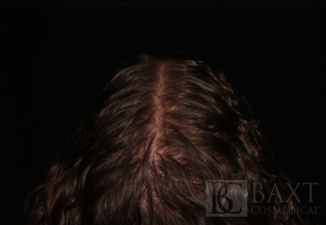 Hair Restoration Peels Before - Paramus, NJ Hair Restoration Before - Paramus, NJ