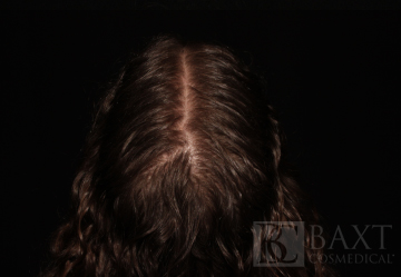 Hair Restoration After - Paramus, NJ Hair Restoration After - Paramus, NJ