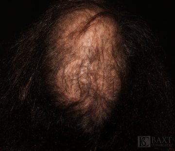 Hair Restoration Before - Paramus, NJ