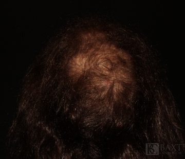 Hair Restoration After - Paramus, NJ